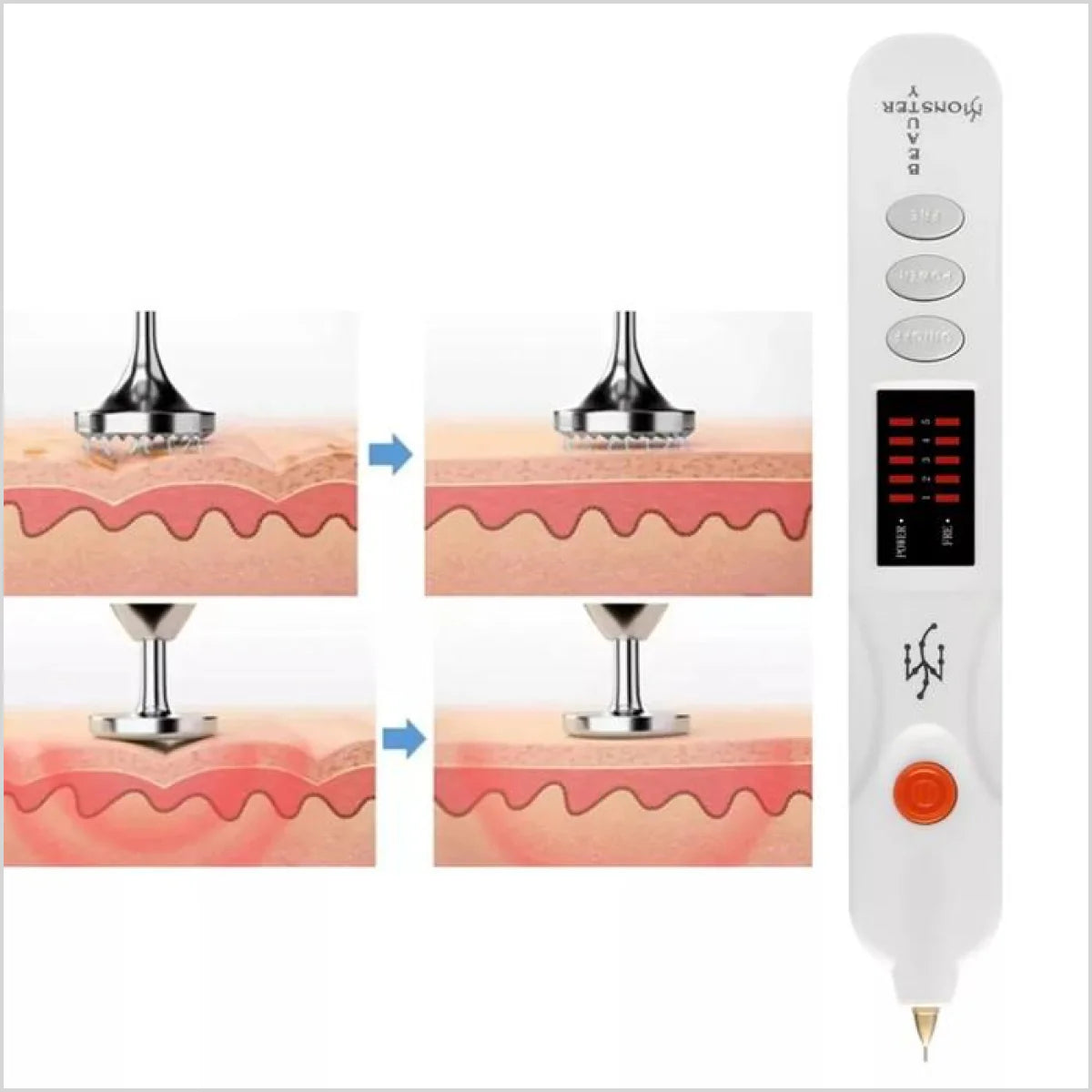 Advanced Beauty Monster Plasma Pen For Stretch Marks